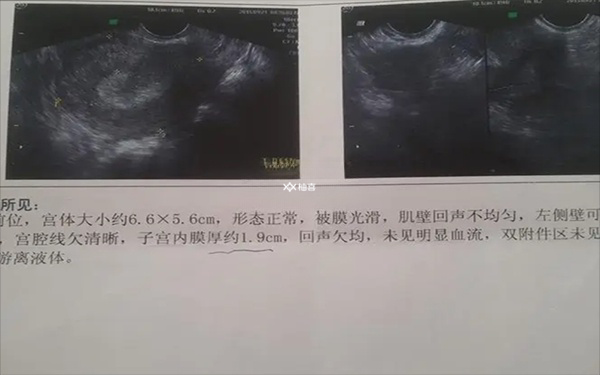 雌激素能不能调节子宫内膜厚度