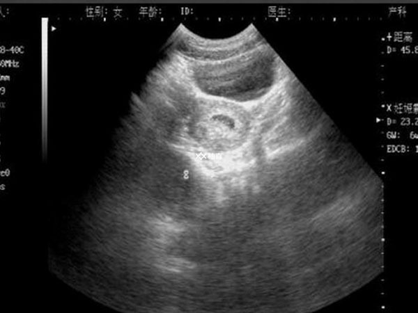 怀女宝的3个孕囊数据是多少