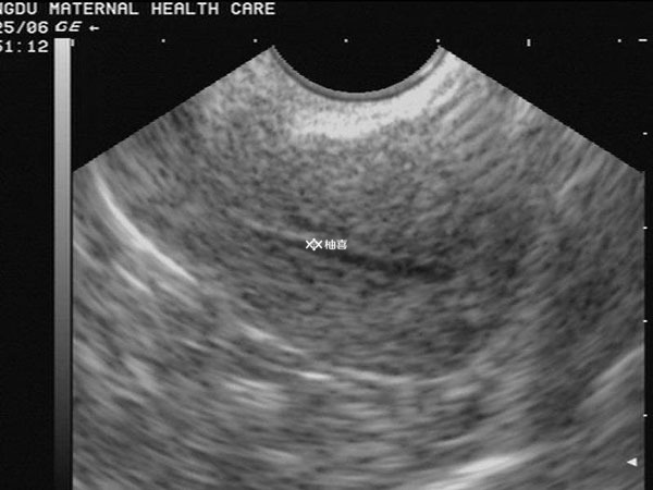 6周孕囊如何看胎儿性别