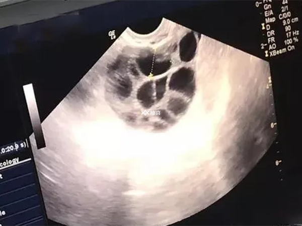 试管取出空卵泡是什么引起的