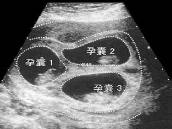 试管会不会导致多胎妊娠