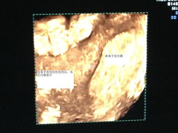内膜厚度会不会影响试管移植