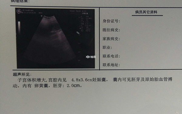 三代试管婴儿胎停是什么引起的