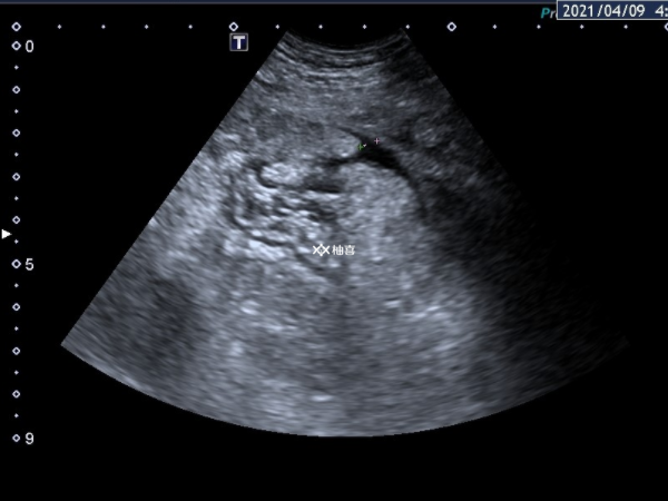 试管促排后有腹水的原因