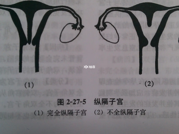 纵隔子宫移植双胎的风险大不大