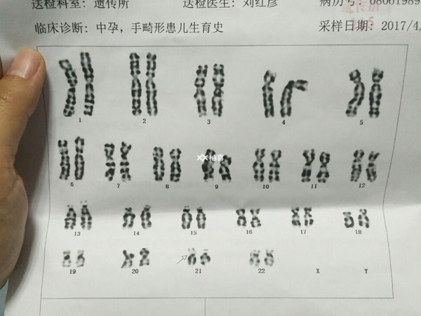 试管婴儿前检查染色体的目的