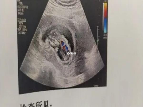 试管婴儿取卵为空泡和什么有关
