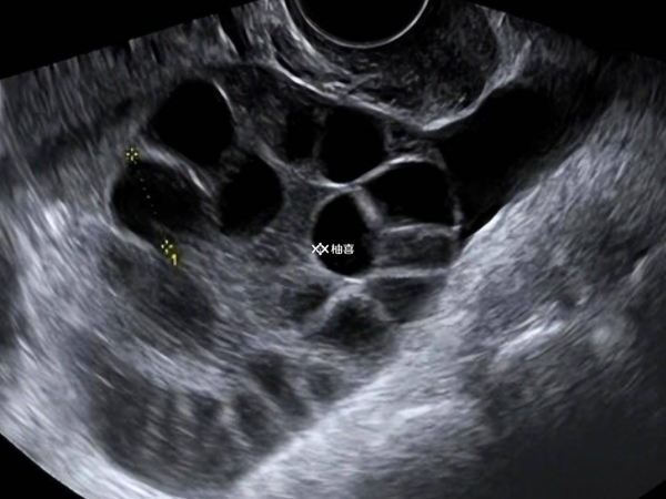 取卵后卵巢增大的不良影响
