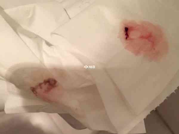 取卵后出血是不是感染了