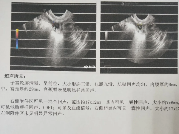 鲜胚移植后腹痛是不是宫外孕