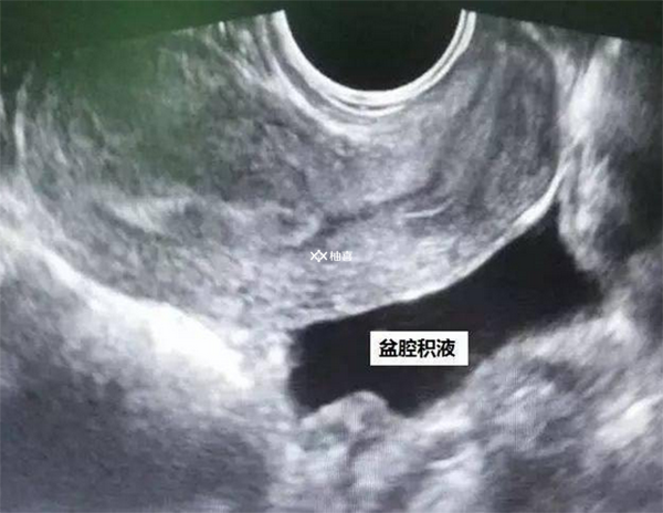 取卵后盆腔有积液能不能做手术