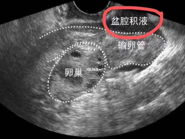 取卵后盆腔有积液能不能运动