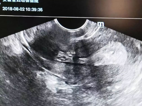 内膜多少试管婴儿移植率高一点