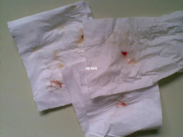 冻胚移植后出血是什么造成的