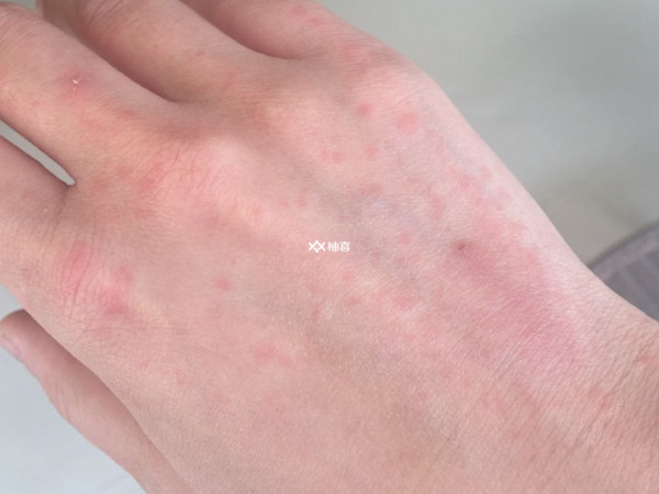 手上起泡是不是过敏
