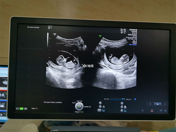 做试管婴儿生双胎会不会有危险