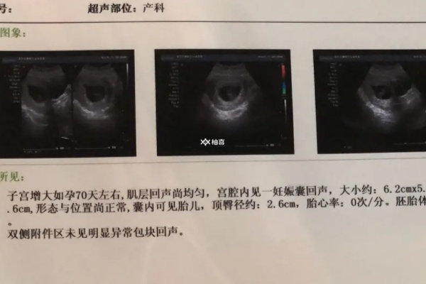 没有早孕反应会不会是胎停了