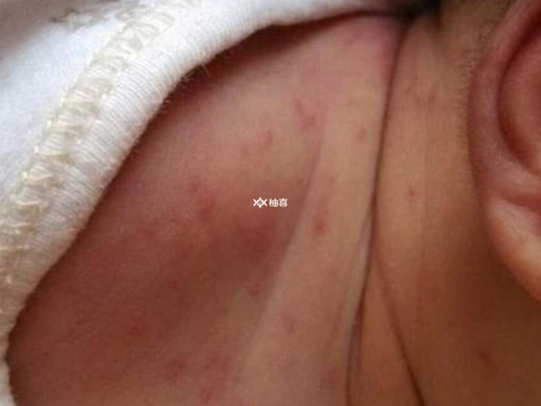 如何判断婴儿对洗发水过敏