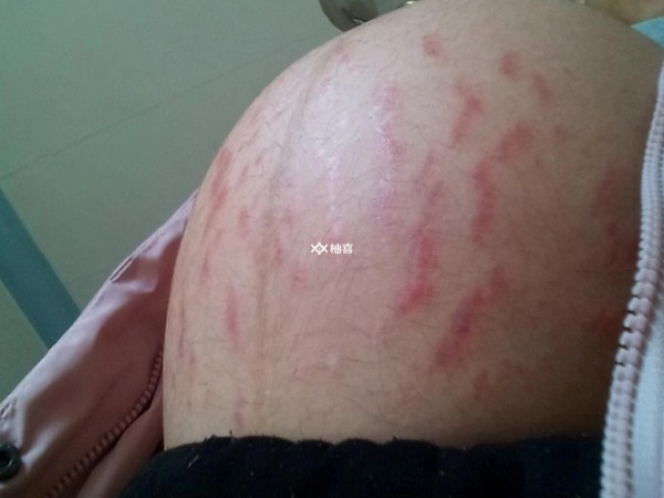 预防妊娠纹的措施