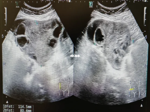 卵巢功能会不会影响卵泡